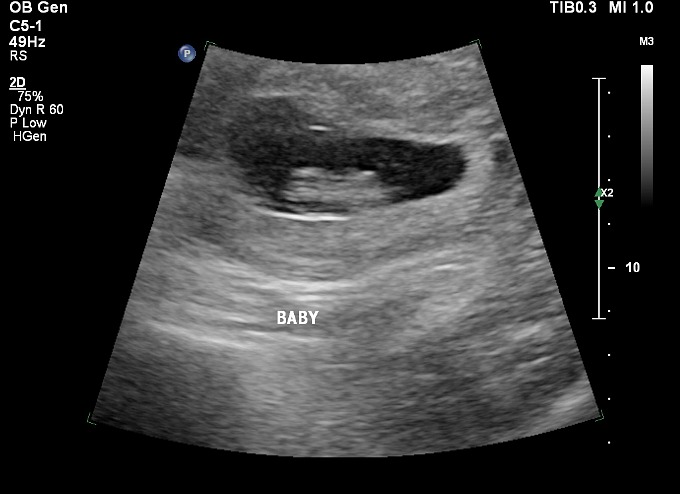 ultrasound 9 weeks